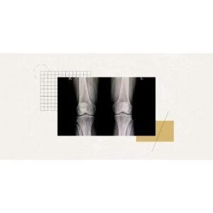 Surprising New Alternative Surgery Offers Relief for Knee Pain - Thumbnail