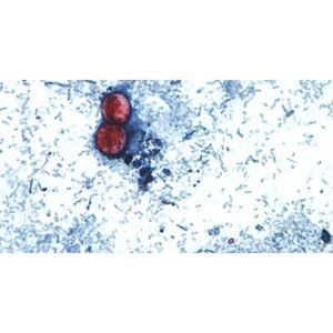 Shocking Taylor Farms Recall: Lettuce Linked to Cyclospora Outbreak - Thumbnail